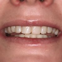Edge Bonding - Smile 1 before